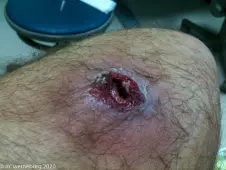 my-abscess,-the-day-after-surgery